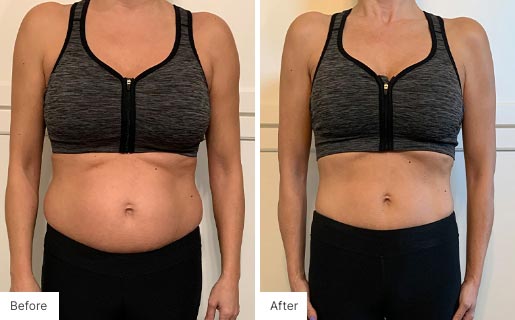 5 - Before and After of a woman's body using NeoraFit.